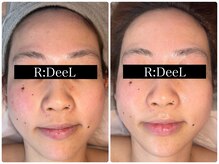 デール(R:DeeL)/肌質改善
