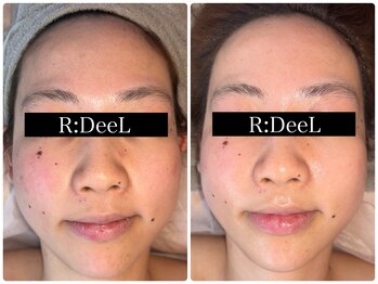 デール(R:DeeL)/肌質改善
