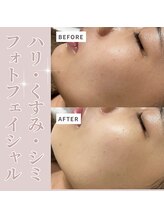 ベル(Belle)/光フェイシャル
