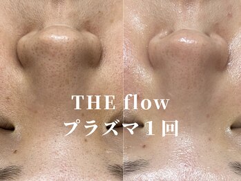 ザ フロウ(THE flow)/プラズマによる毛穴の変化