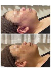 ザ ベスト ビューティー(The Best Beauty)/コンフィット脂肪ケア