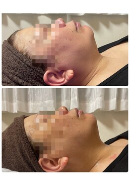 ザ ベスト ビューティー(The Best Beauty)/コンフィット脂肪ケア