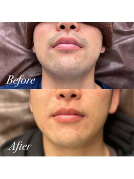 メンズ脱毛サロン ボス(BOSS)/清潔感をお求めの方必見！