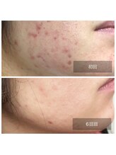 ミドリ(MIDORI)/繰り返すニキビ徹底ケア症例1-2