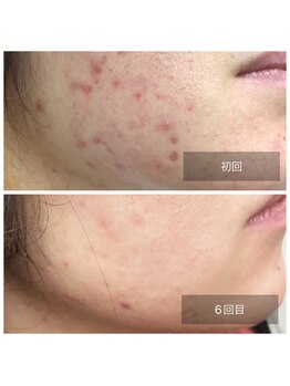 ミドリ(MIDORI)/繰り返すニキビ徹底ケア症例1-2