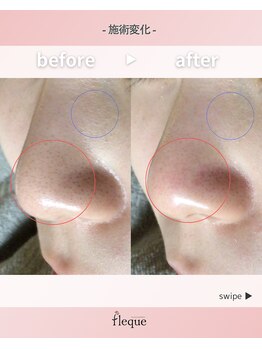 フレク(fleque)/ハーブピーリング+毛穴ケア1回