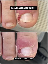 巻き爪じゅん 千葉駅前店/陥入爪による痛みが改善！