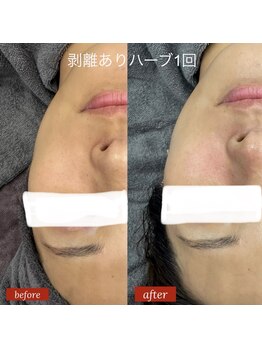 ノイ(noi.)/ソフト・ハーブピーリング症例