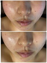 マリエンドリー/ニキビ改善◎