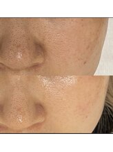 マリヴェリーテ(Mari verite)/毛穴黒ずみ、開き改善