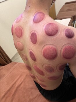 優勝リラ!!/任せコース吸玉