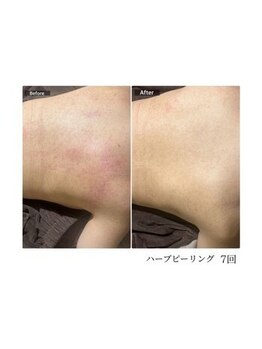 エミルカ 鹿児島店(EMILUCA)/ハーブピーリング