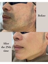 ルラ 池袋東口店(LULA)/ヒゲ脱毛