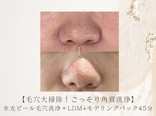 アネラボーテ(Anela Beaute)/毛穴徹底洗浄コース