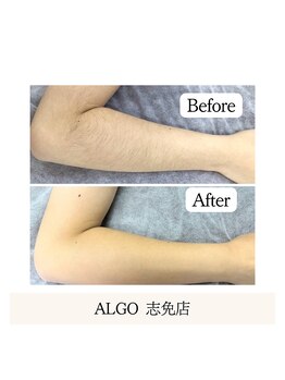 アルゴ 志免店(ALGO)/自己処理は肌への負担も大。