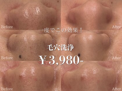 Pluien大阪堀江【韓国肌管理／毛穴洗浄／毛穴ケア／毛穴／小顔／ピーリング】の写真