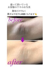 ツリービューティー(Tree Beauty)/ワキ脱毛黒ずみも綺麗に！