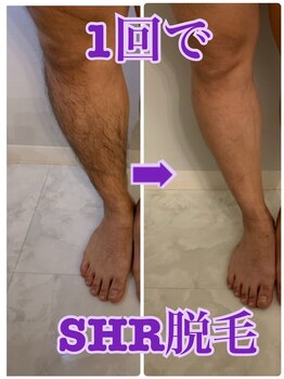 ミカ ネスト(Mika Nest)/光脱毛 / 光脱毛