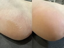 ネイル スパ ココプラス(Nail spa Cocoplus)/フットケア 角質ケア