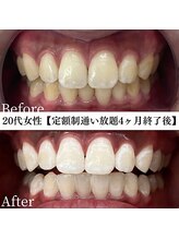 ホワイト 福岡天神店(WHITE)/ホワイトニングビフォーアフター