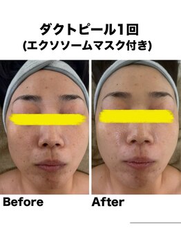 マーレン(Malen)/ダクトピール症例写真