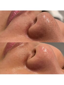 ミューズ(MUSE)/エクストラクション＋顔脱毛