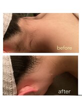 ゲッカ(GEKKA)/うなじ襟足脱毛