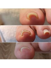 爪切り屋 足楽/巻いた爪◆リフトアップ