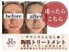【人気No.2】 トラブル肌緩和に◎REVIハーブピーリング×IPS美容液