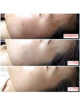 ミュー(Mieux)/素肌に自信がつきました！