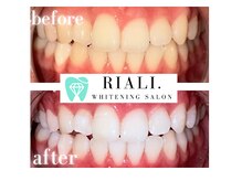 リアリ 宮崎(RIALI.)/プラチナホワイトニング
