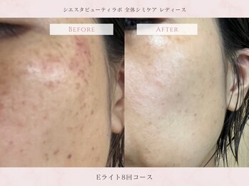シエスタビューティラボ/【シミ改善コース】8回後