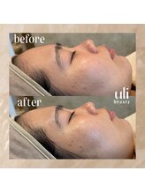 ウリ(uli beauty)/比較写真