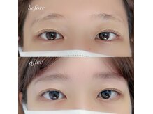 ニム(nim)/Hollywood brow lift