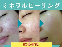 ビースキン 広島(BE:SKIN)の雰囲気（当店人気NO.1！コスパ最強/同時施術で効果UP◎）