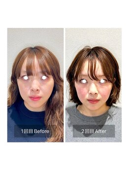 ウル(ulu)/電気を流す美容鍼2回