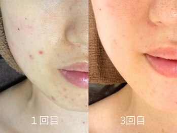 エミルカ 日の出平井店(EMILUCA)/フェイスラインのニキビや跡にも