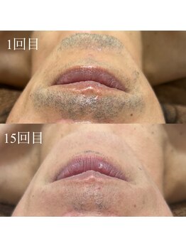 ランプ(LAMP)/~ハイブリッドヒゲ脱毛~