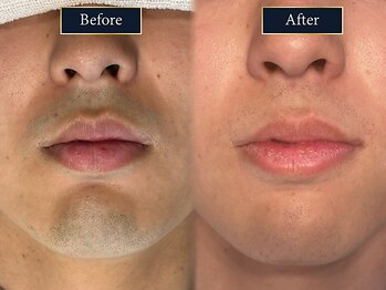 グラスト(Grast)/ヒゲ脱毛|福岡/大橋/天神/博多