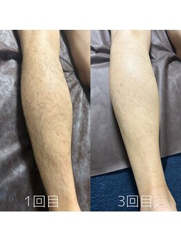 カナウ(KANAU)/足脱毛（20代前半男性）