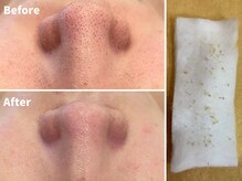 ファシー 四日市(fachi.)/黒ずみ毛穴除去＋開き毛穴引締め