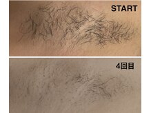 サロンドカプリス(salon de Caprice)の雰囲気（ルミクス脱毛！しっかり効果！ワキ脱毛2000円！学生さんに人気♪）