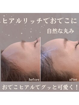 クリニカルボーテ 心斎橋院(CLINICAL BEAUTE)/まん丸なおでこが叶う！