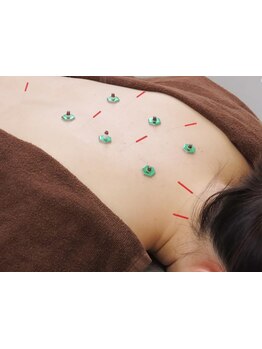 鍼灸施術を受けたい