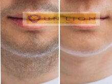 アン リオン(UN LiON)/顔・首脱毛18回