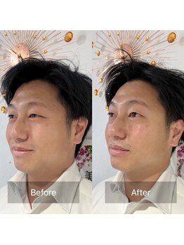 アネラ 難波(ANERA)/30代男性 小顔/浮腫み