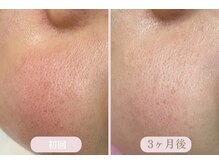 エピル(EPIL)/スキンケアセット症例