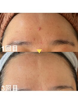 クレア(Claire)/ハーブピーリング