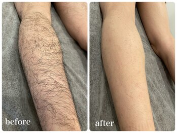 エリクサー 加須店(Elixir)/3回の照射でまばらに!