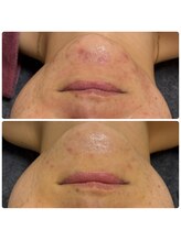 シュガー(Sugar...iyr)/ハーブで肌質改善！！